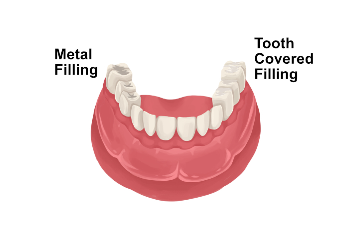 tooth_covered_filling.jpg